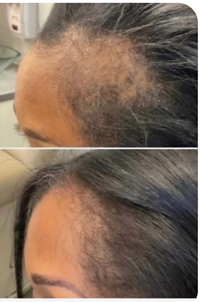Hair transplant for African American female patient